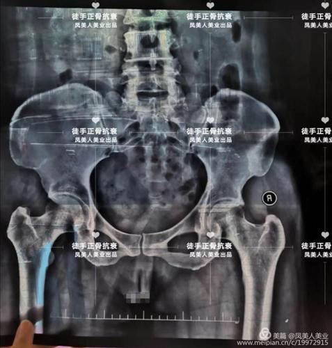 徒手身材骨雕抗衰管理为什么比市面普通骨盆闭合的效果好?