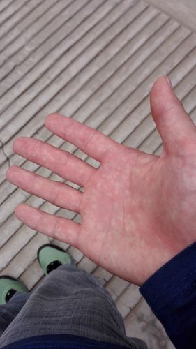 手掌上这种情况有事么