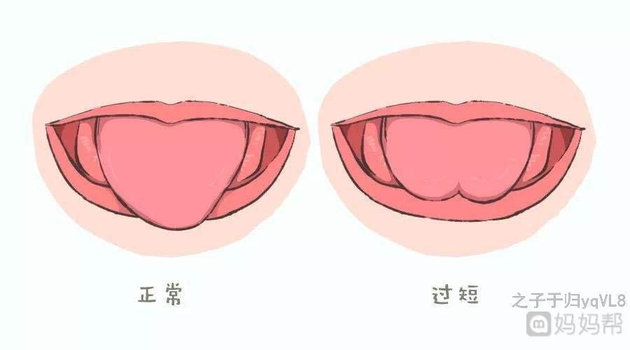 宝宝的舌头像右边的,以前以为是正常的,今天才明白是舌系带