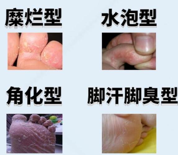 2020美国治疗脚气,灰指甲及鸡眼的药膏推荐