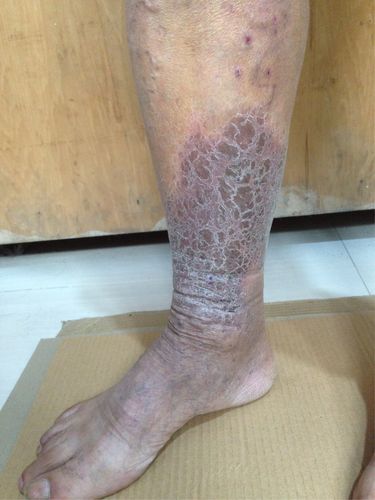 静脉曲张并发淤积性皮炎精准微创治疗后一周效果对比