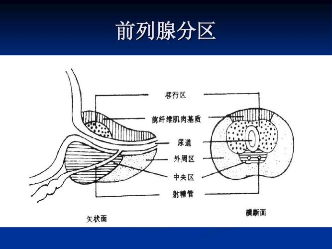 前列腺癌的mr诊断ppt