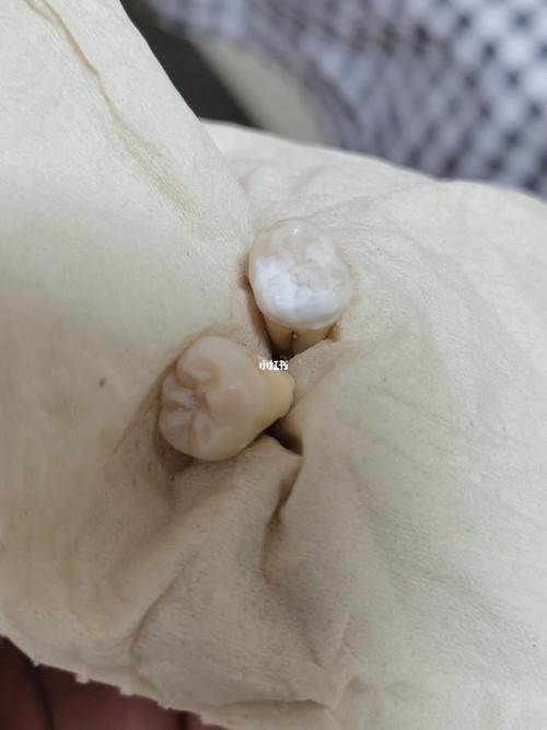 求助,见图二,拔完的智齿为啥有一块那么白_智齿