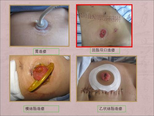 造口并发症的处理