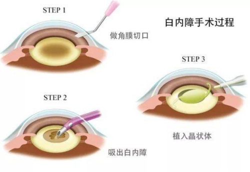 白内障 简要手术过程(图片来自网络)