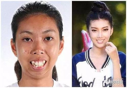 19岁丑女满口龅牙被人嘲笑,整容后变成了大美女