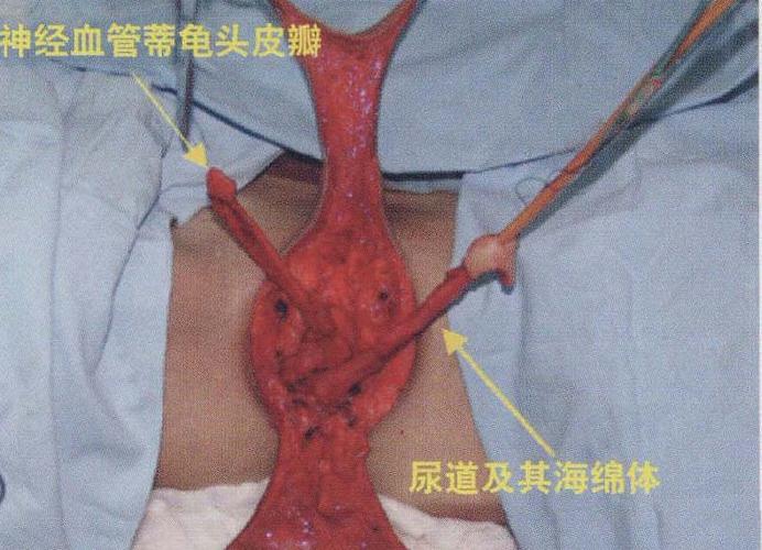 典型病例2:阴茎-阴囊皮瓣法阴道成形术 神经血管蒂龟