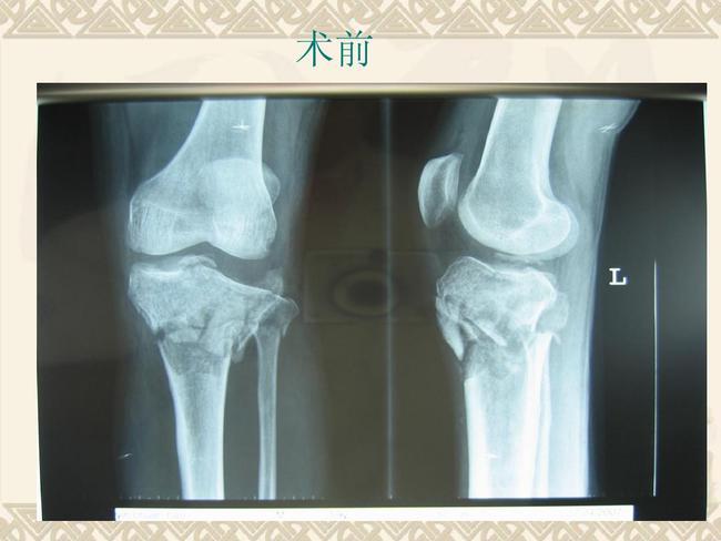 在胫骨骨折中,由于胫骨前内侧肌的缺损,肌力不平衡,前内侧突出常发生