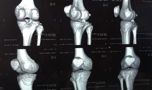 右侧胫骨平台塌陷也超过了3mm,影响膝关节关节面的平整及膝关节的