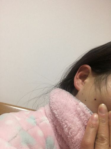 有的说这三颗痣是三星吉兆