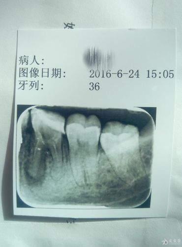各位老师看看这是根尖囊肿吗?