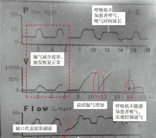 常见异常呼吸波形解读