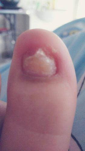 今天去医院看过,医生说是厚指甲,怎么办,有什么方法可以治好?