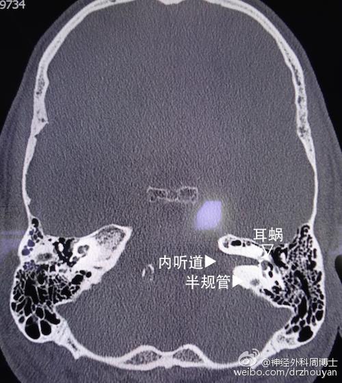 了解后半规管与内听道起始部之间的距离.