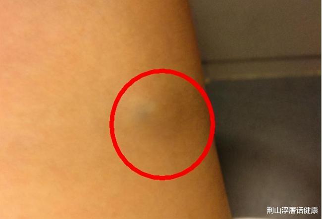 脂肪瘤的致病原因是啥,会