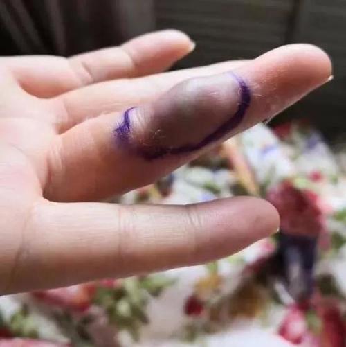 哈尔滨辣妈单手拎了10斤菜 手指被勒出血管瘤