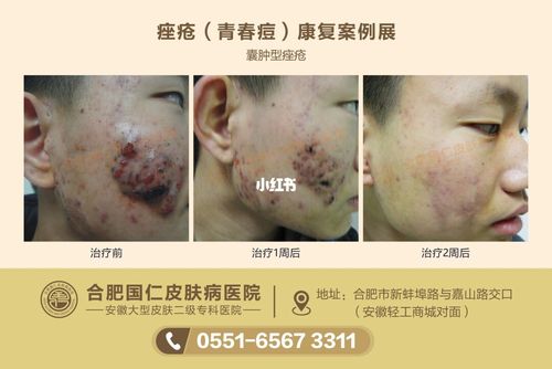 青春痘怎么办_皮肤病_皮肤科_痘痘_皮肤医院_药膏_美妆_护肤