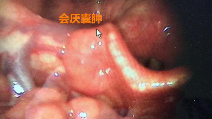 会厌囊肿都需要手术吗