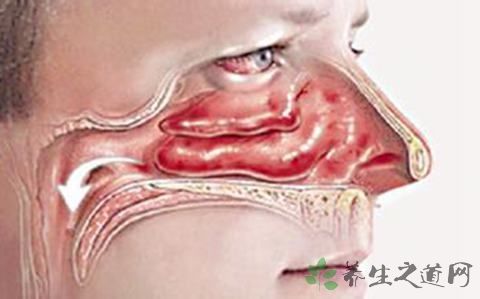 什么是双侧上颌窦炎