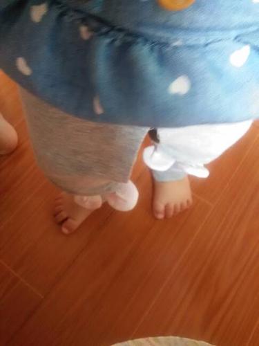 宝宝一岁了了,刚学会走路,一只脚正的,一只脚外八