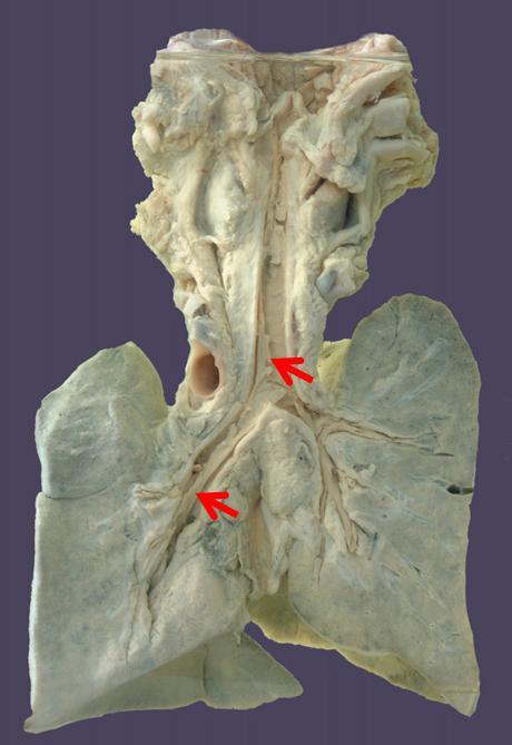 肺脓肿,假膜c.白喉,假膜d.