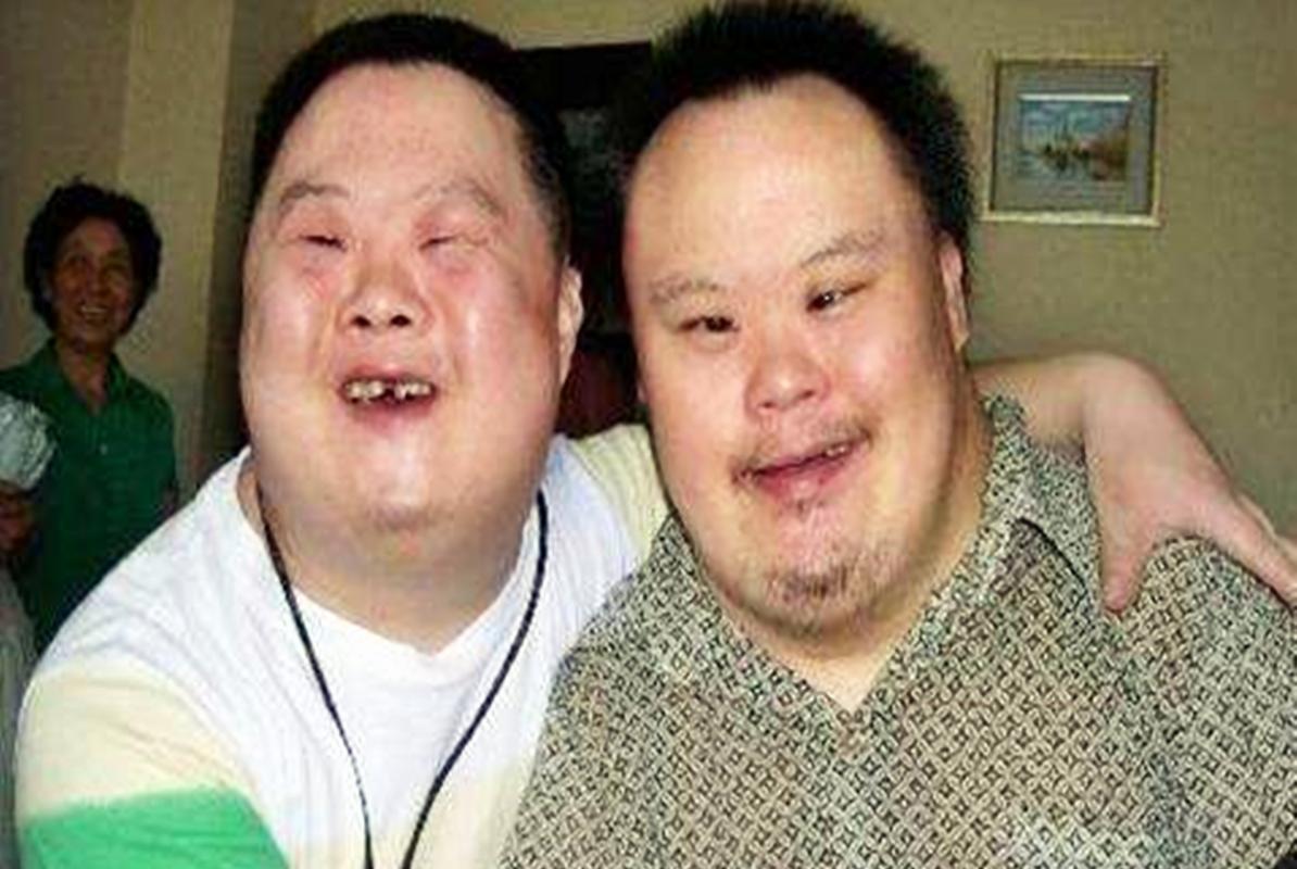 "断掌"是唐氏儿的表现?两处体貌特征暗示患病,预防从怀孕抓起