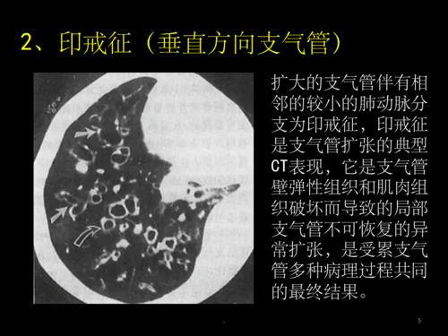 手把手教你支气管扩张ct诊断