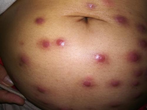 段芳会,女,1968年 症状:1.气短2.皮肤病(疮/血毒)两星期前犯的3.