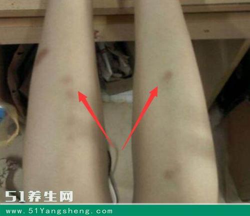 身上总是出现不明原因的淤青?当心可能是这些疾病的信号!