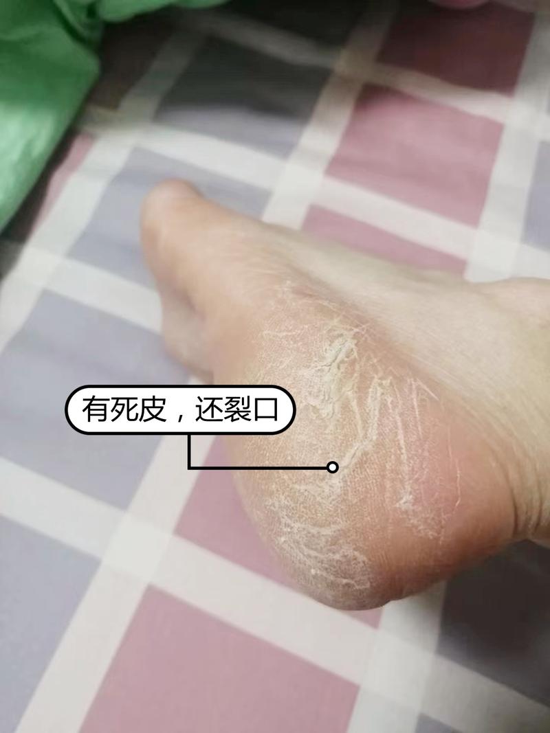 角质增厚,易裂脚