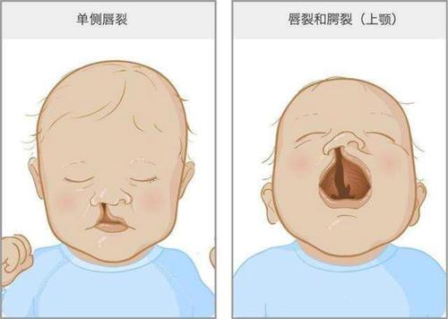 口腔医学兔唇是什么怎么治疗兔唇