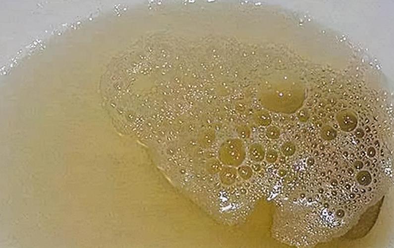 长期堆积在肾脏处,冲击了肾脏的过滤功能,就会出现泡沫丰富的蛋白尿