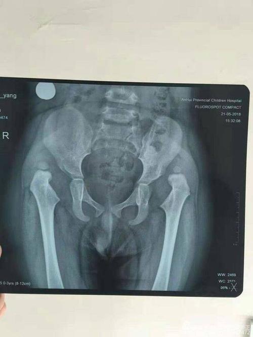 幼儿先天性髋关节脱位治疗方法是手术治疗还是选择保守治疗家长必看