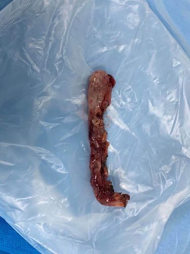 姚孟办事处社区卫生服务中心昨晚急诊完成阑尾炎手术——腹腔镜下阑尾