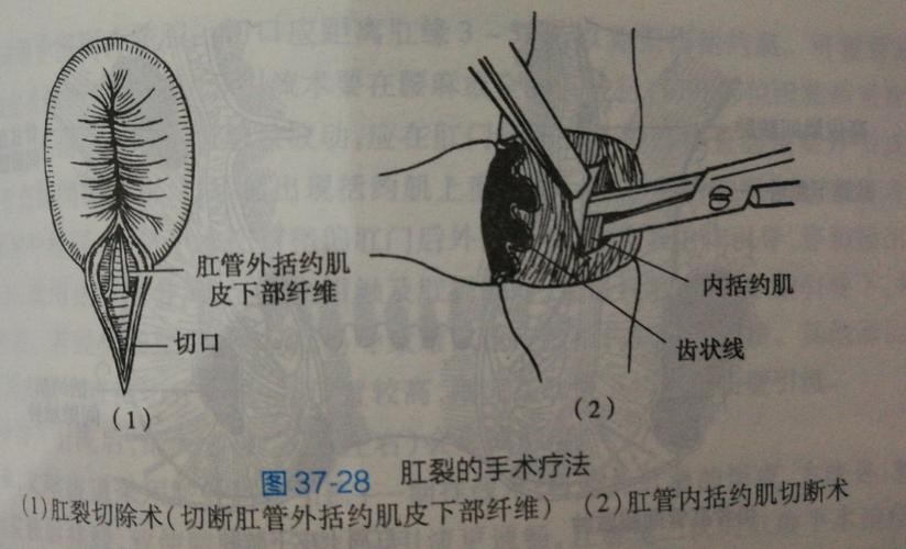 必要时手术治疗肛裂!