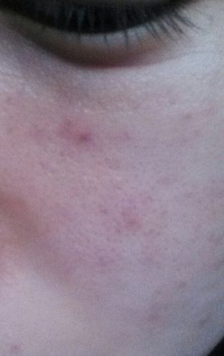 脸上长了个红点,在肌肤表层里面,外面摸着平平的.