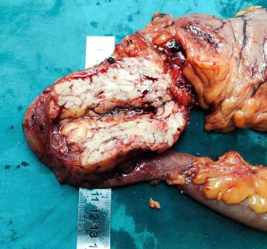 我科完成根治性胰十二指肠切除术1例