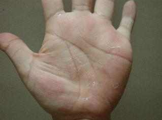 艾滋病初期的皮疹症状是什么样的 引起艾滋病的原因