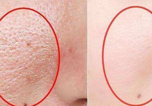 品毛孔里挤出的白色细条是什么东西白头粉刺可以用鸡蛋清去除吗