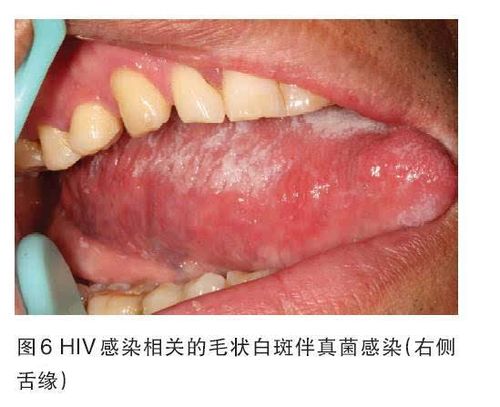 aids患者和hiv携带者很多存在口腔病损,你能发现它们么?