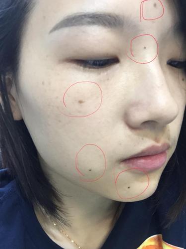 我脸上痣比较多  有可能我家基因就这样  我爸我爷都是这样 点痣前