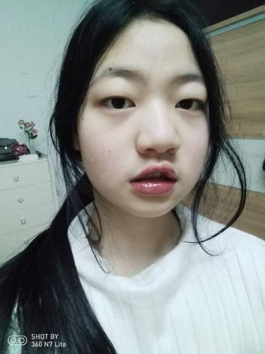 前面两个牙齿有一点突出,但是我有点三角嘴_圈子-新氧