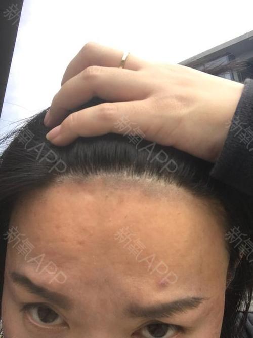 氧气jsb2e06脱发际线术后第19天美丽日记_新氧整形