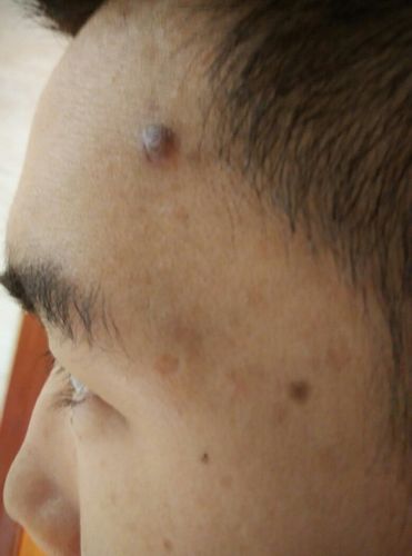 之前长痘痘留下的,现在变成类似肉疙瘩了,已经有两个月了,不知道是