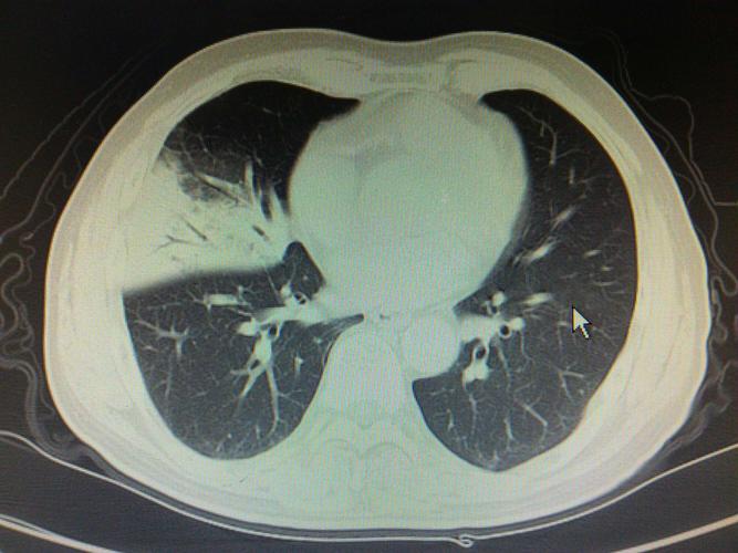 大叶性肺炎一例
