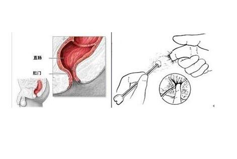 肛周脓肿怎么办才好