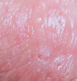 包皮溃疡起小水泡