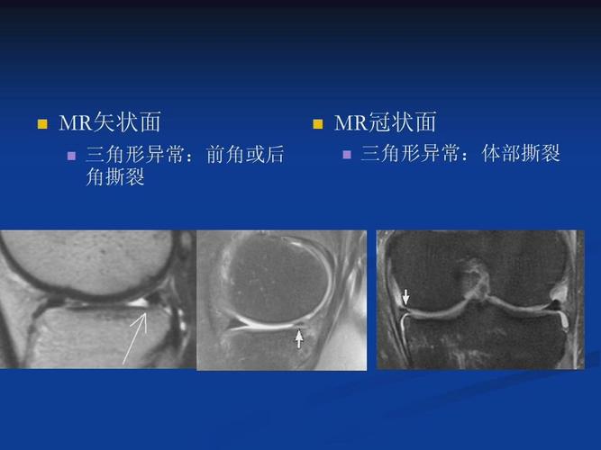 磁共振室业务学习～2019.07.05～膝半月板撕裂