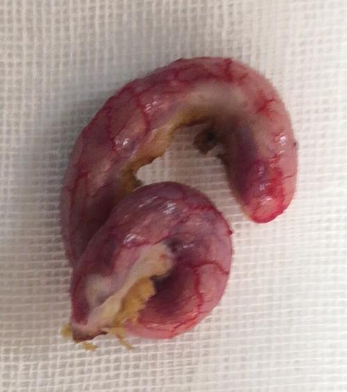 小女孩的阑尾炎,就是阑尾太长,扭曲了,里面有很多粪石