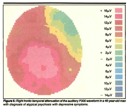 computer analysis of the electroencephalogram